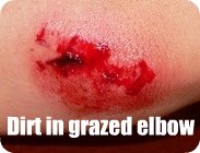 grazed elbow