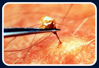 Bee sting first aid deals