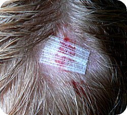 cut head steri strips