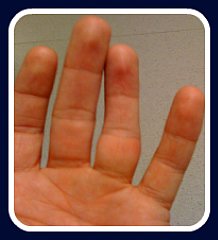 first aid for dislocated finger