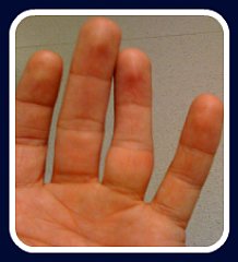 first aid for dislocated finger