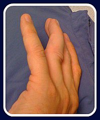First Aid for dislocated finger