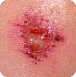 grazed knee scab